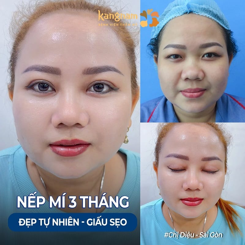 Mí mắt vào form chuẩn đẹp