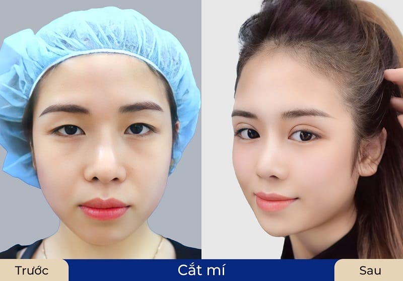 Nếp mí vào form và cân đối với gương mặt