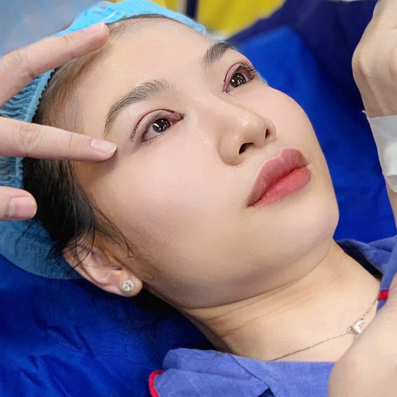 Khi vừa cắt mí vết thương sẽ hơi sưng tấy trong vài ngày đầu