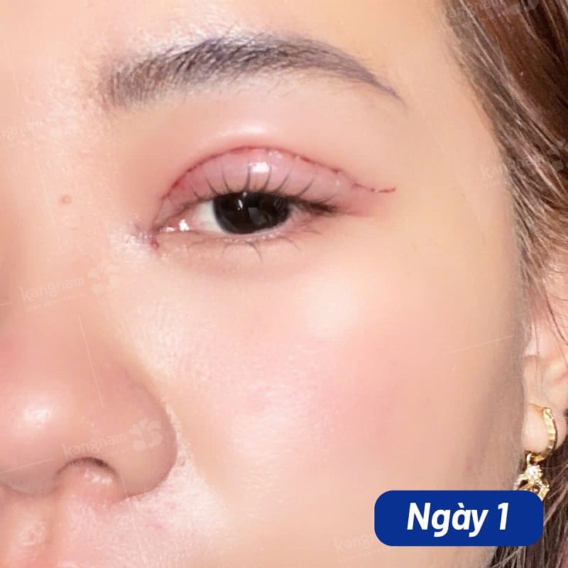 Khi mới cắt mí vết thương sẽ sưng tấy và hơi đỏ