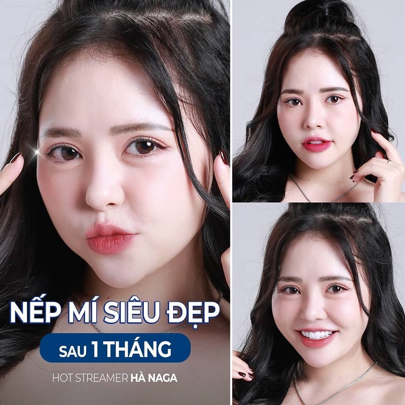 Nếp mí đẹp tự nhiên và ổn định sau vài tháng