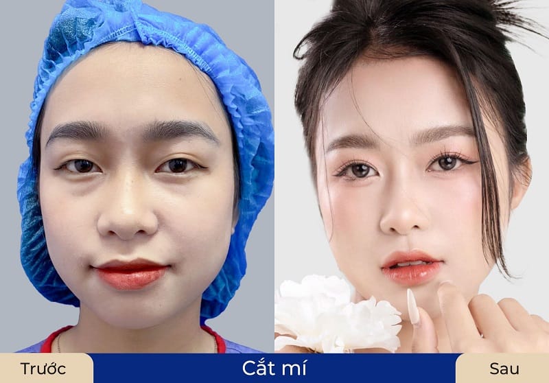 Nếp mí nhanh chóng đẹp tự nhiên và lâu dài