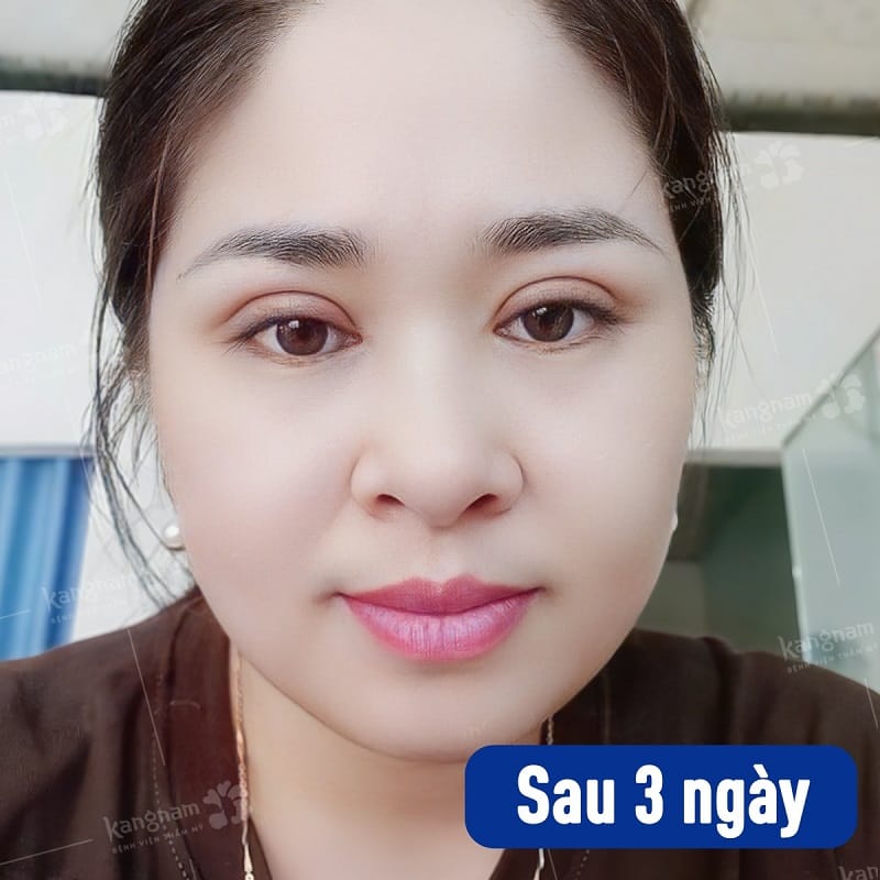 Mí mắt sau 3 ngày vẫn còn sưng tấy