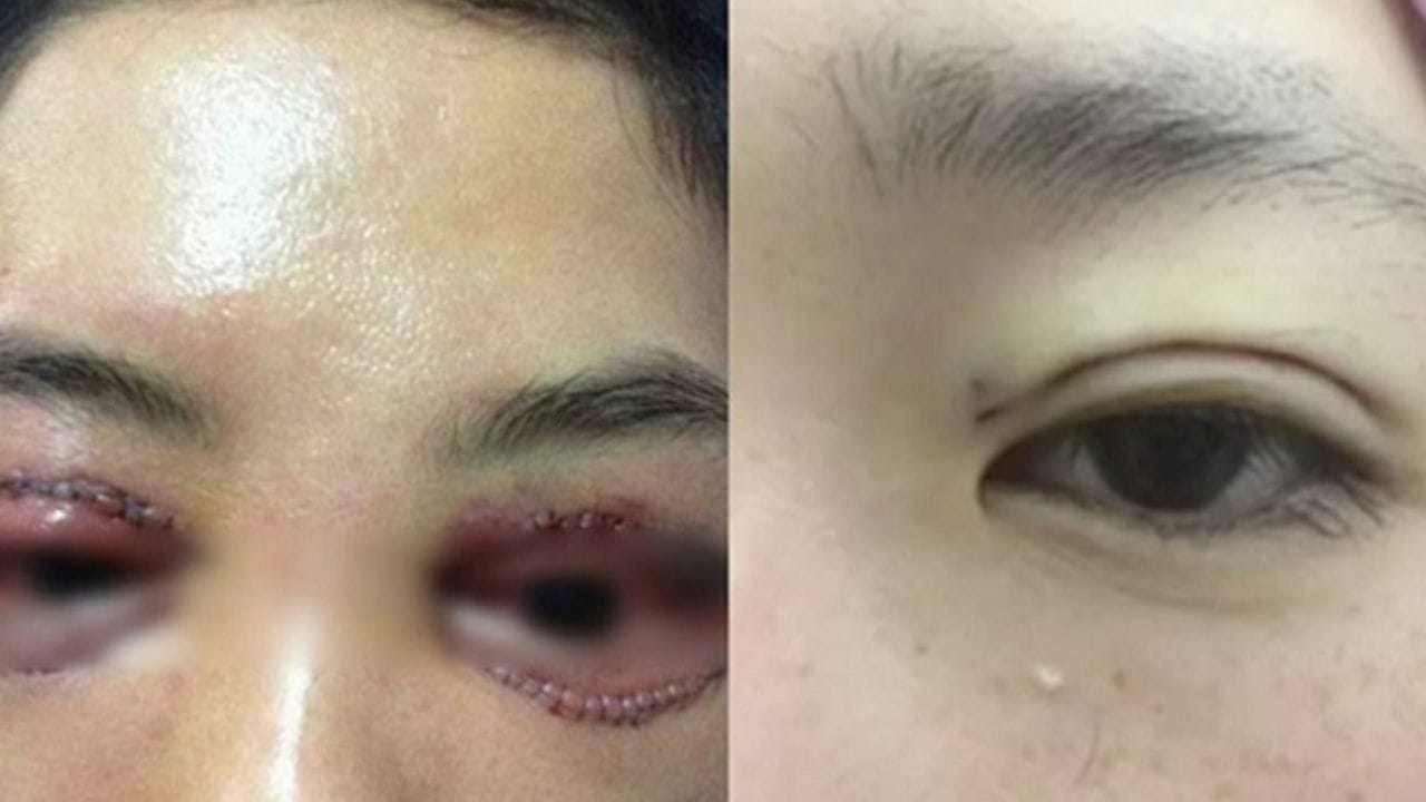 Cắt mí mắt có hại không? Những nguy cơ có thể xảy ra