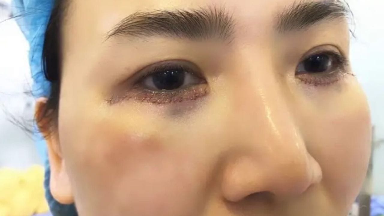 Cắt mí dưới có để lại sẹo không? Cách phòng tránh hiệu quả