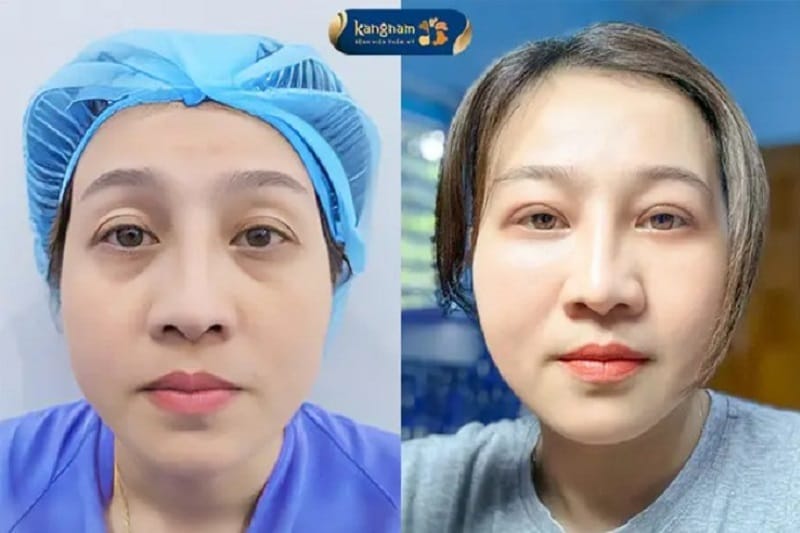 Cắt mí dưới đúng kỹ thuật sẽ không để lại sẹo