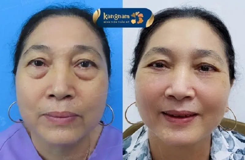 Khách hàng cắt mí dưới tại Kangnam, nếp mí tự nhiên, không để lại sẹo