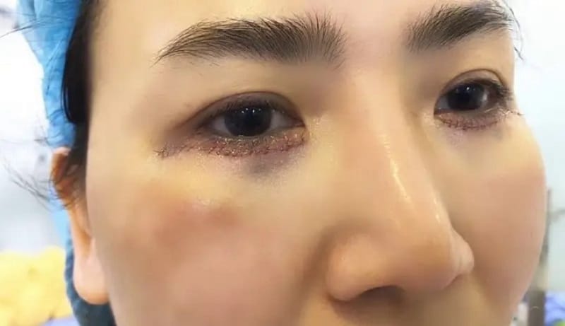 Đường mí cứng, gồ ghề sẽ để lại sẹo