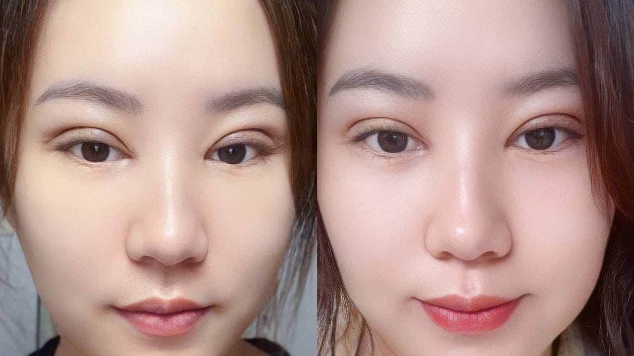 Cắt mí mắt bao lâu hết sưng? Những cách khắc phục hiệu quả