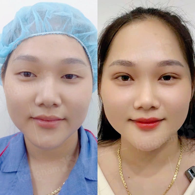Mí mắt hết sưng và ổn định