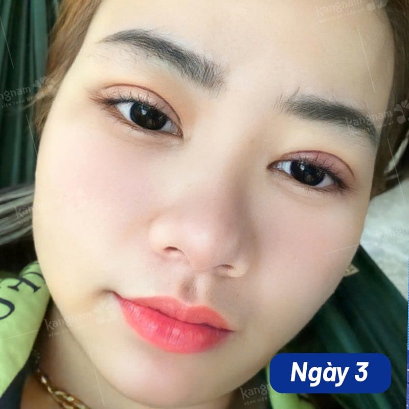 Sau khi vừa cắt mí vết thương sẽ sưng tấy và bầm tím
