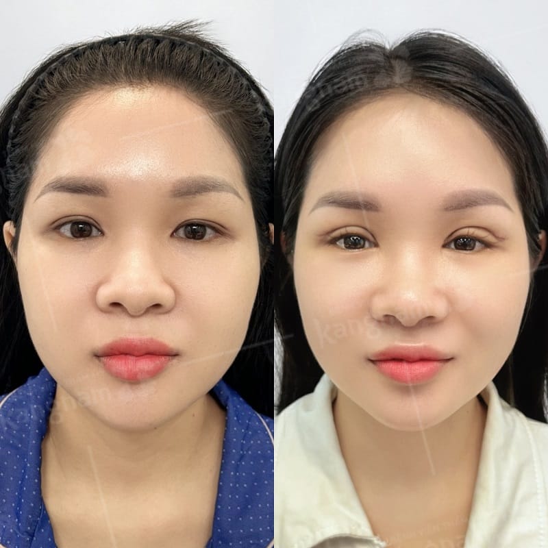 Sau khoảng 2 tuần nếp mí của khách hàng đã ổn định hơn