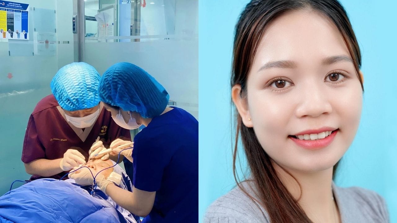 Cắt mí mắt ở đâu đẹp? Gợi ý 4 địa chỉ cắt mí mắt uy tín