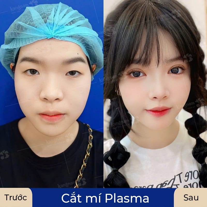 Bạn khách thăng hạng nhan sắc sau cắt mí