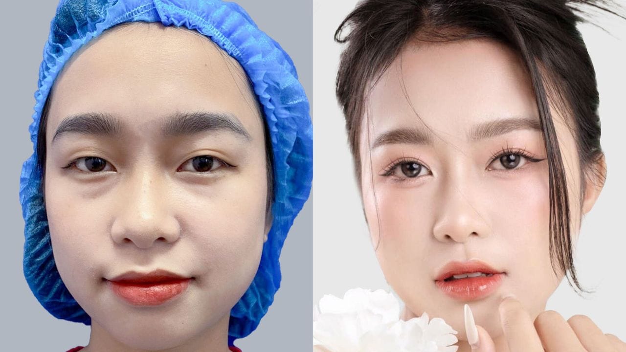 Cắt mí mấy tháng thì đẹp? Thời gian phục hồi cụ thể