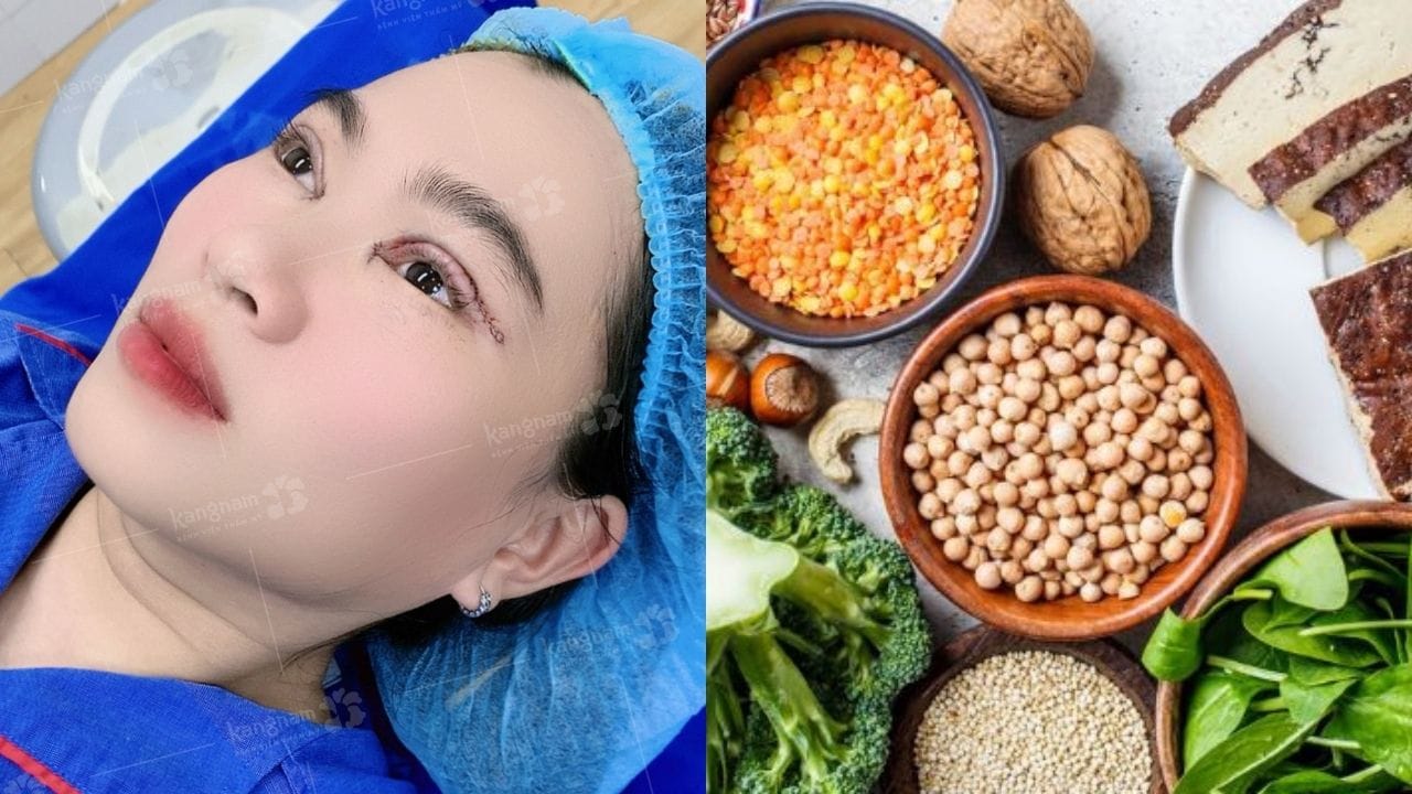 Cắt mí nên ăn gì cho mau lành? Top các thực phẩm nên ăn