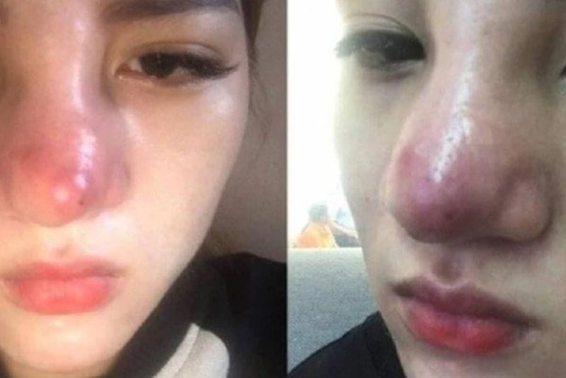 Dấu hiệu mũi bị viêm thường sưng tấy, đỏ, đau nhức kéo dài