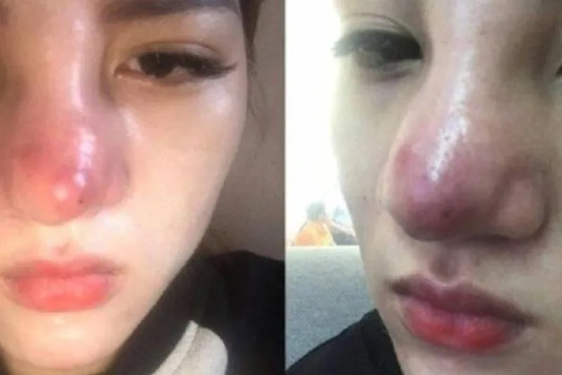 Signs of nasal inflammation typically include swelling, redness, and persistent pain or soreness. 