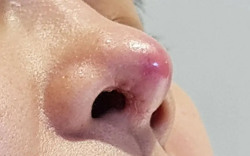 Chăm sóc hậu phẫu sai cách khiến vùng mũi viêm nhiễm