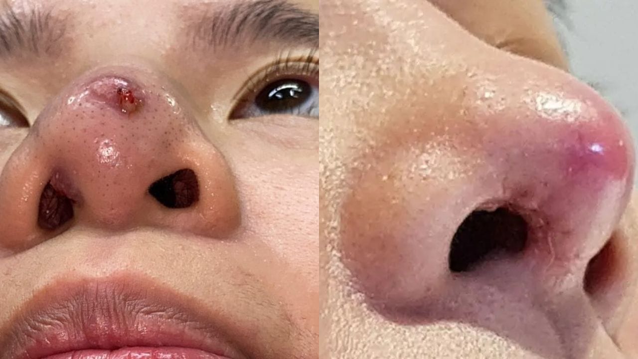 7 Dấu hiệu nâng mũi bị viêm và cách xử lý kịp thời