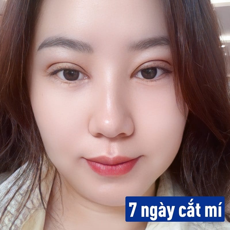 Mí mắt sẽ hết sưng sau vài ngày cắt mí