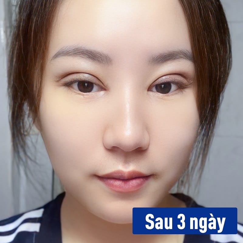 Những ngày đầu cắt mí vết thương sẽ hơi sưng