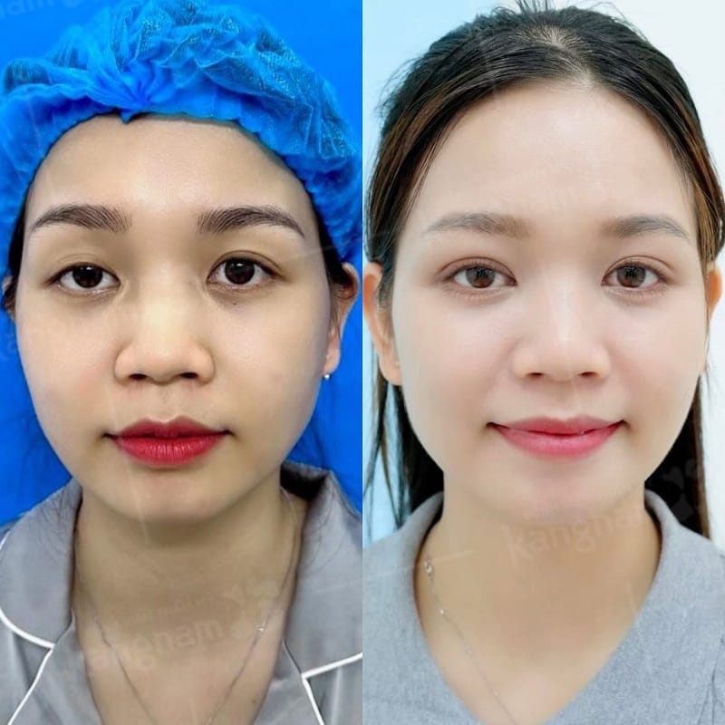 Mí mắt cân đối và ổn định khi tuân thủ cách chăm sóc của bác sĩ