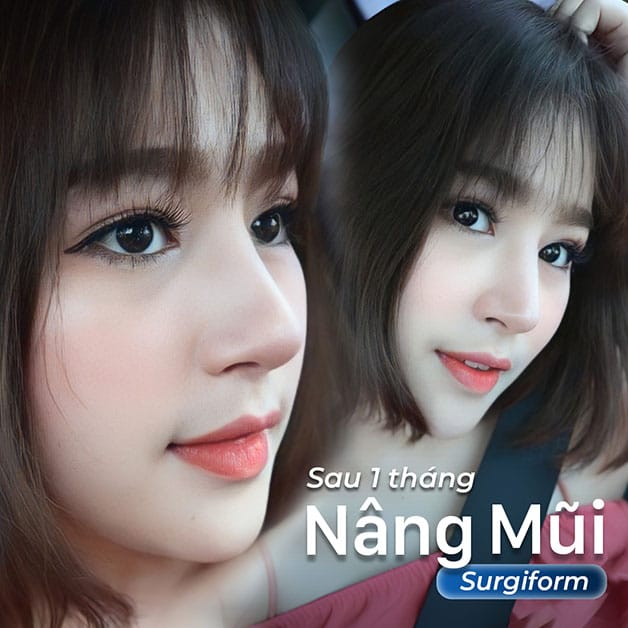 Nâng mũi gom lại không làm mũi thấp đi