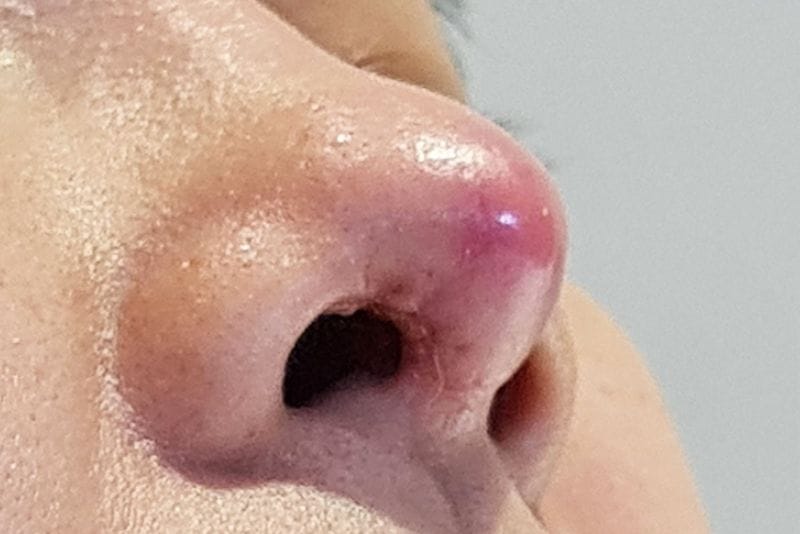 Lộ sụn đầu mũi nhìn thấy rõ qua lớp da đầu mũi