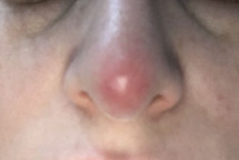 Không hợp sụn cũng là nguyên nhân khiến lộ sụn nâng mũi