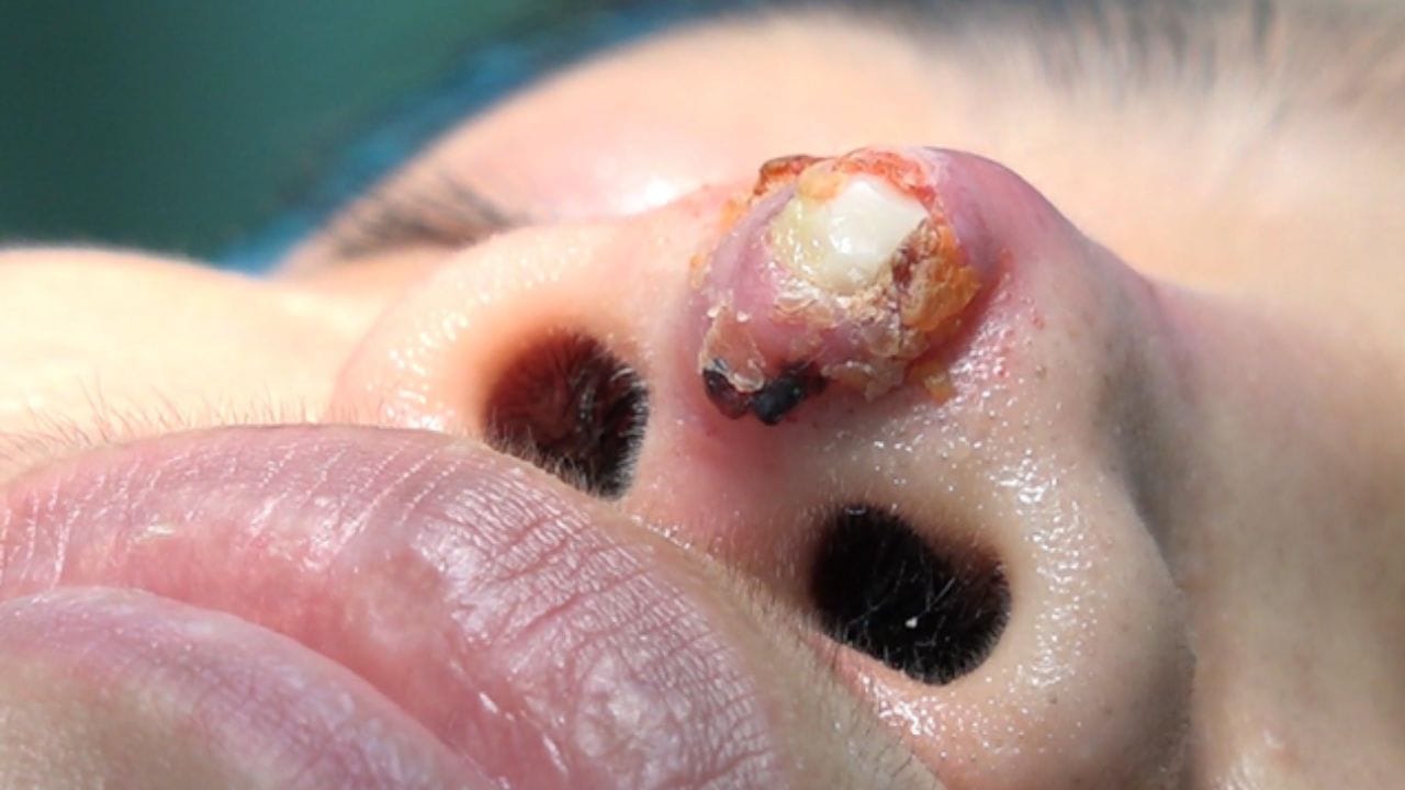 Lộ sụn đầu mũi: Nguyên nhân, dấu hiệu và cách khắc phục an toàn