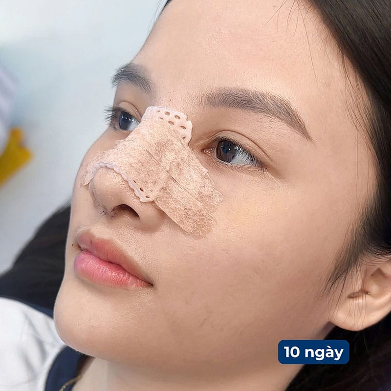 Nâng mũi xong không nên nằm nghiêng để tránh gây áp lực đến vùng mũi