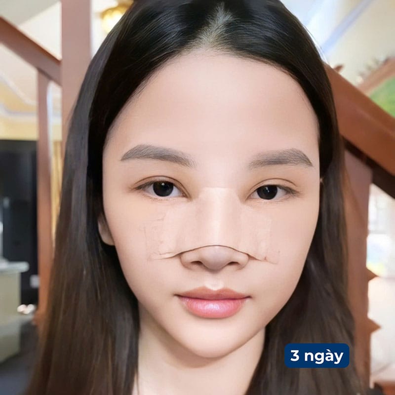 Tránh va chạm mạnh trong những ngày đầu sau nâng mũi