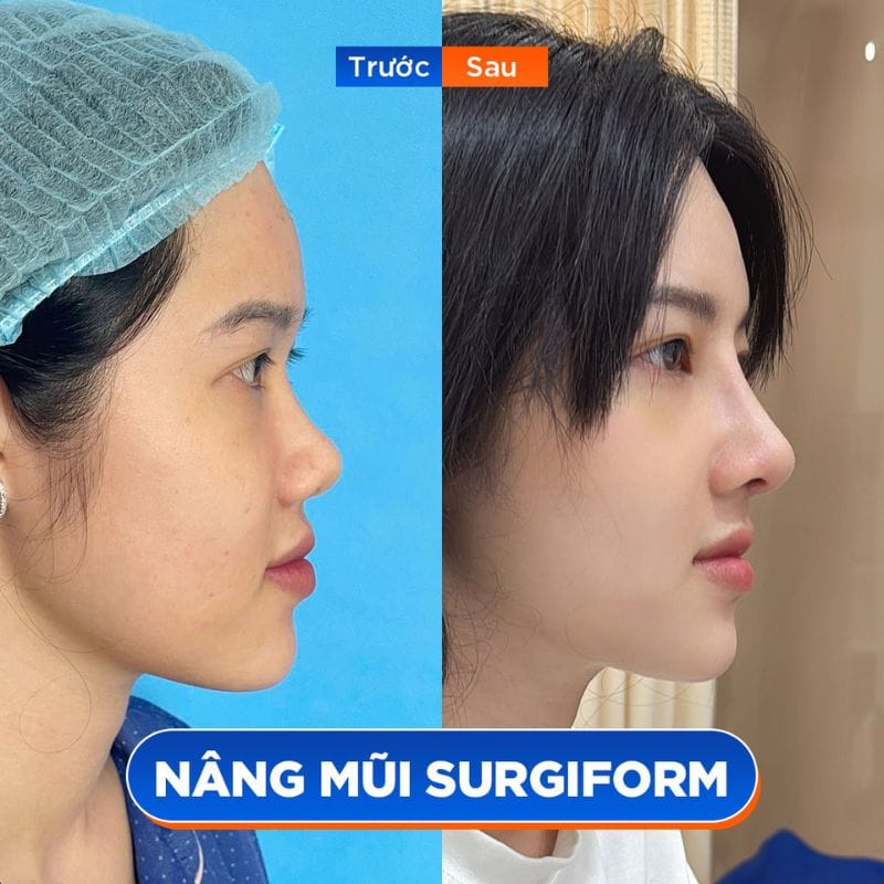 Nâng mũi bọc sụn phù hợp với dáng mũi nhiều khuyết điểm