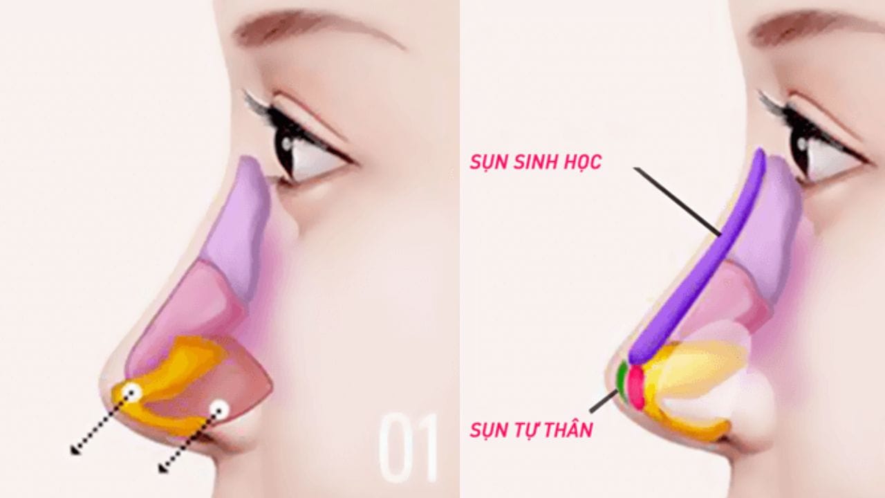 Nâng mũi bán cấu trúc là gì? Liệu có phù hợp với bạn
