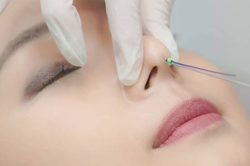 Loại chỉ và chất lượng chỉ ảnh hưởng đến kết quả nâng mũi