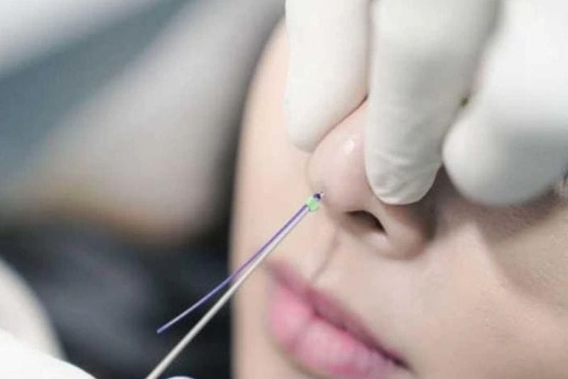 Nâng mũi bằng chỉ giữ được