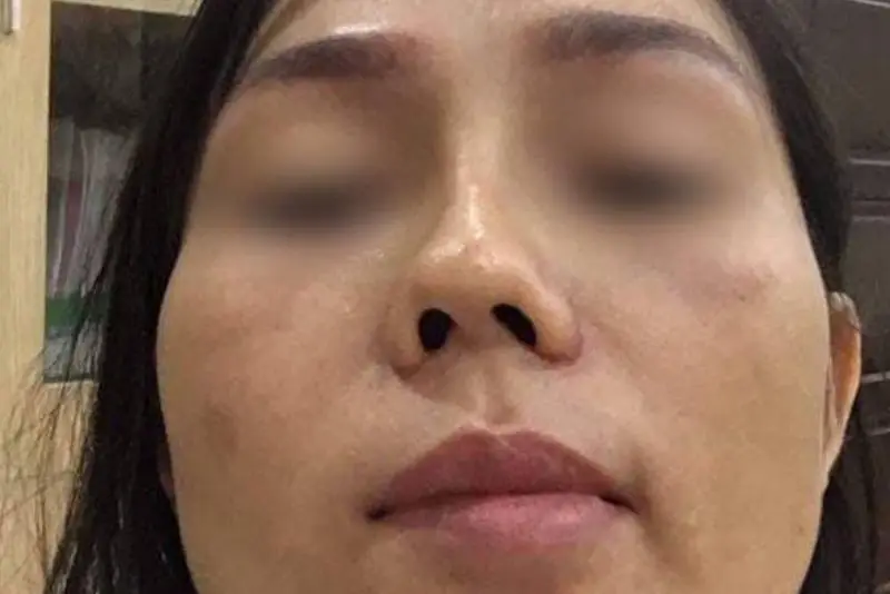 Mũi biến dạng do tình trạng viêm không được xử lý sớm