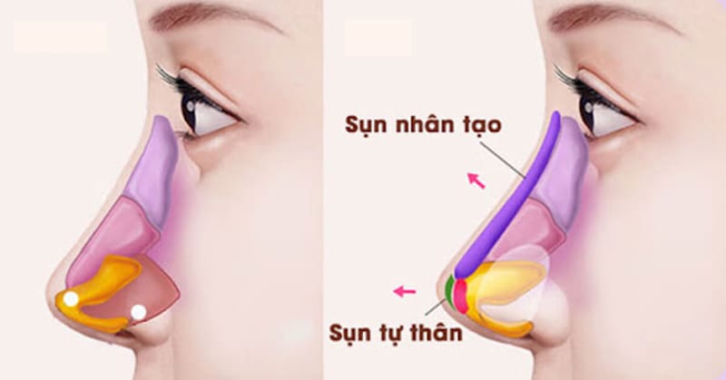 Nâng mũi bán cấu trúc chỉ can thiệp một phần cấu trúc mũi