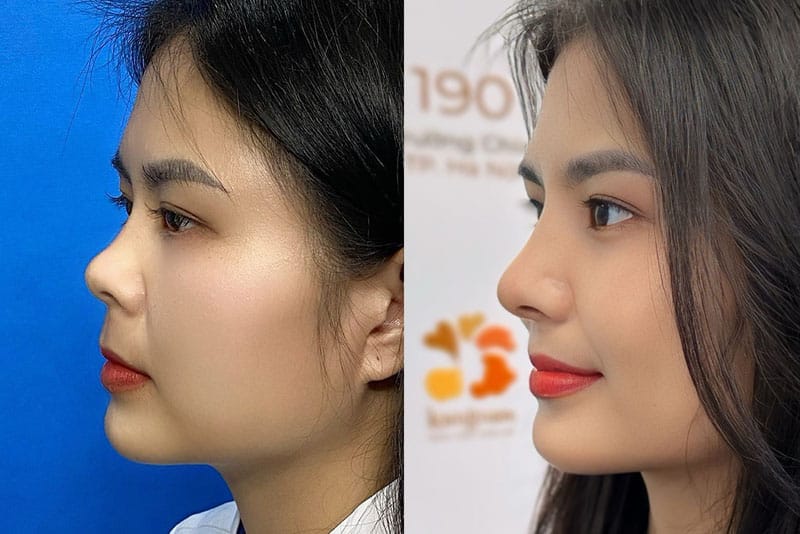 Nâng mũi cấu trúc