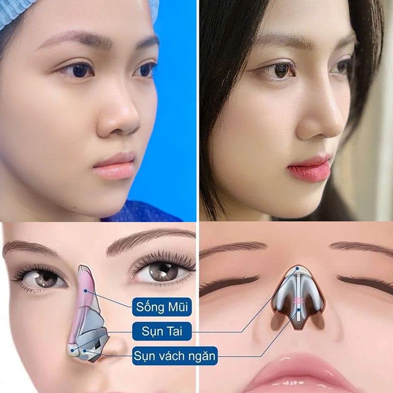 Nâng mũi cấu trúc