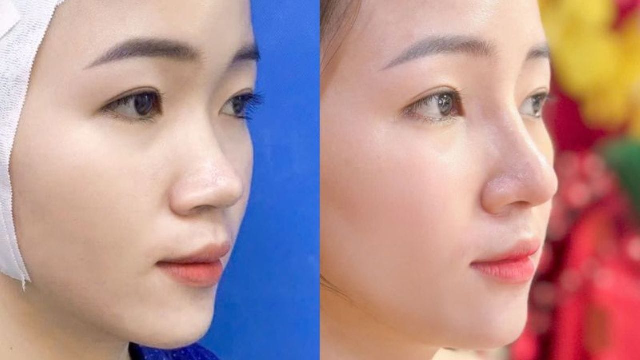 Nâng mũi cấu trúc là gì? So sánh với các phương pháp khác