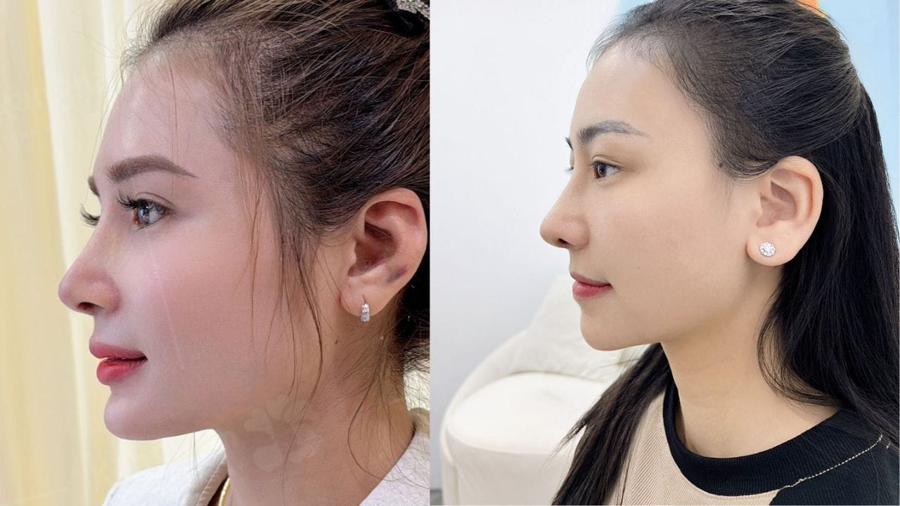 Nâng mũi gom lại có thấp không? Cách để mũi nhanh vào form đẹp