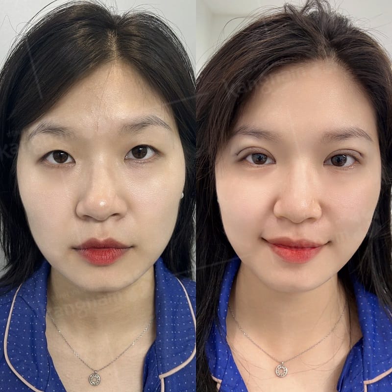 Khách hàng sau nhấn mí tại Kangnam, nếp mí cân đối, tự nhiên