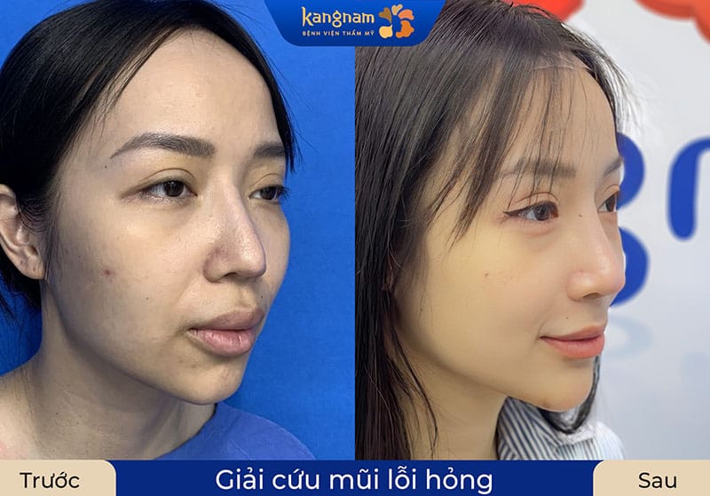 Kangnam tái cấu trúc mũi cho trường hợp mũi hỏng, lộ sụn