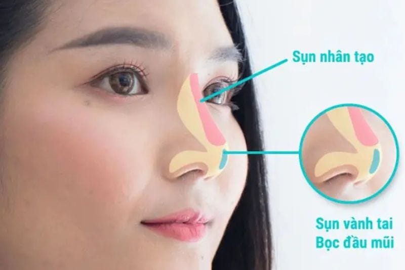 Sụn mũi là vật liệu chính giúp định hình dáng mũi, nâng cao sống mũi