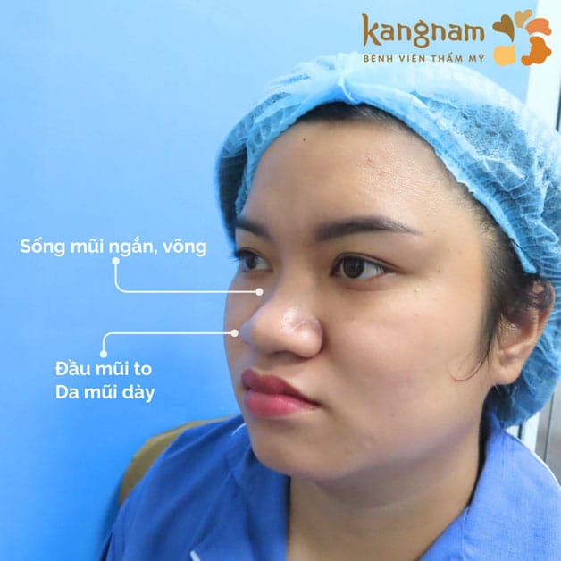 Mũi nhiều khuyết điểm không phù hợp với phương pháp căng chỉ