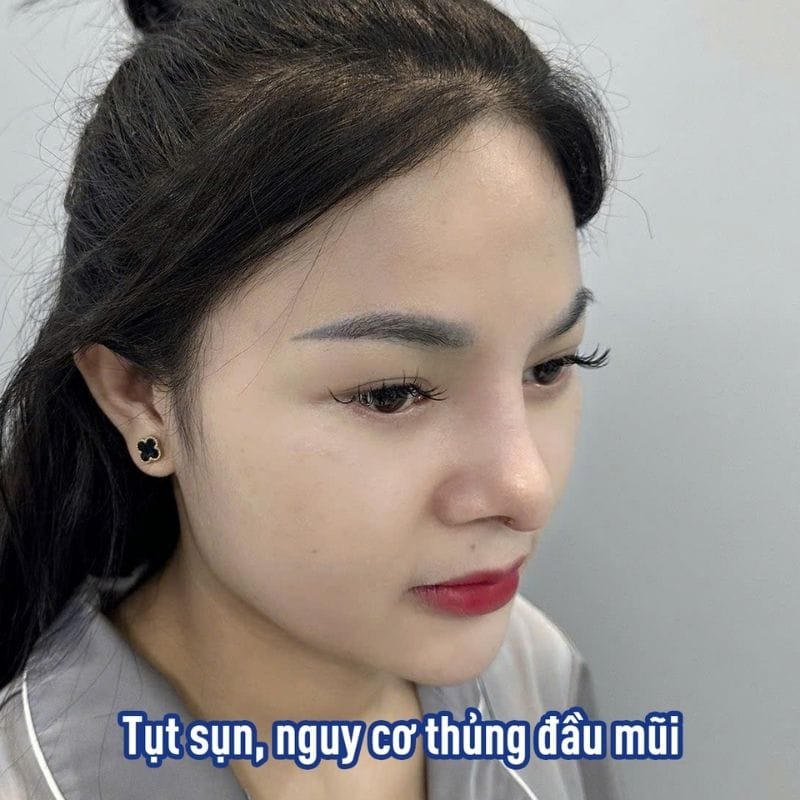 Mũi tụt sụn từ lần nâng mũi trước đó nên cân nhắc nâng mũi cấu trúc