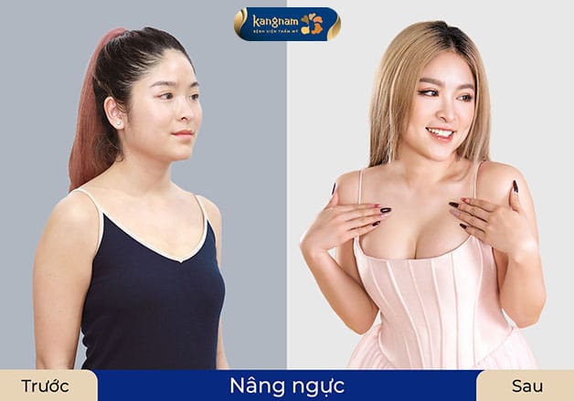 Việt kiều Úc nâng ngực tại Kangnam sở hữu vòng 1 quyến rũ