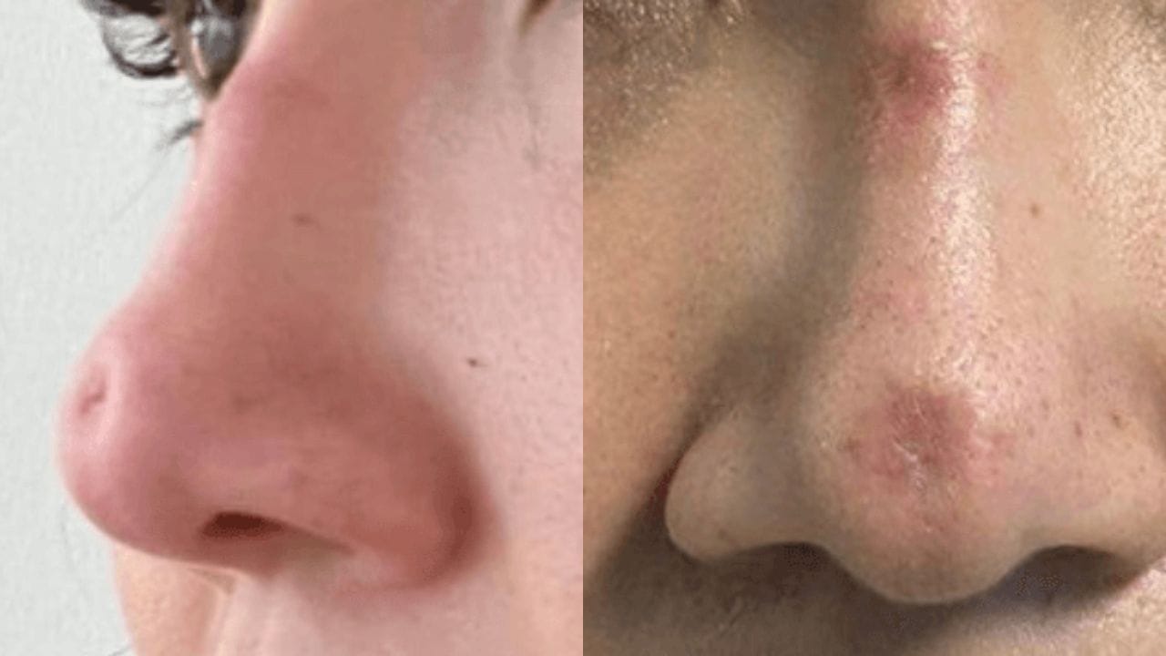 Biến chứng nâng mũi bằng chỉ và cách phòng tránh